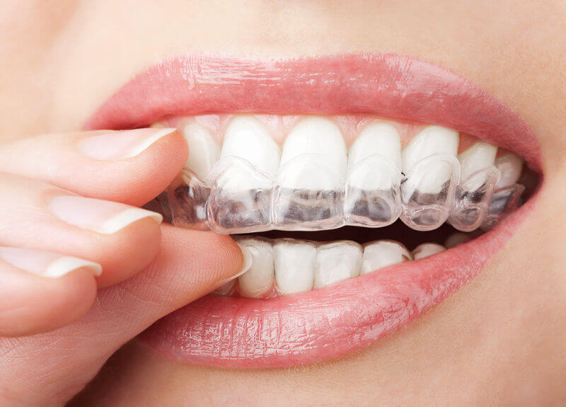 Invisalign treatment and benefits woburn dentist